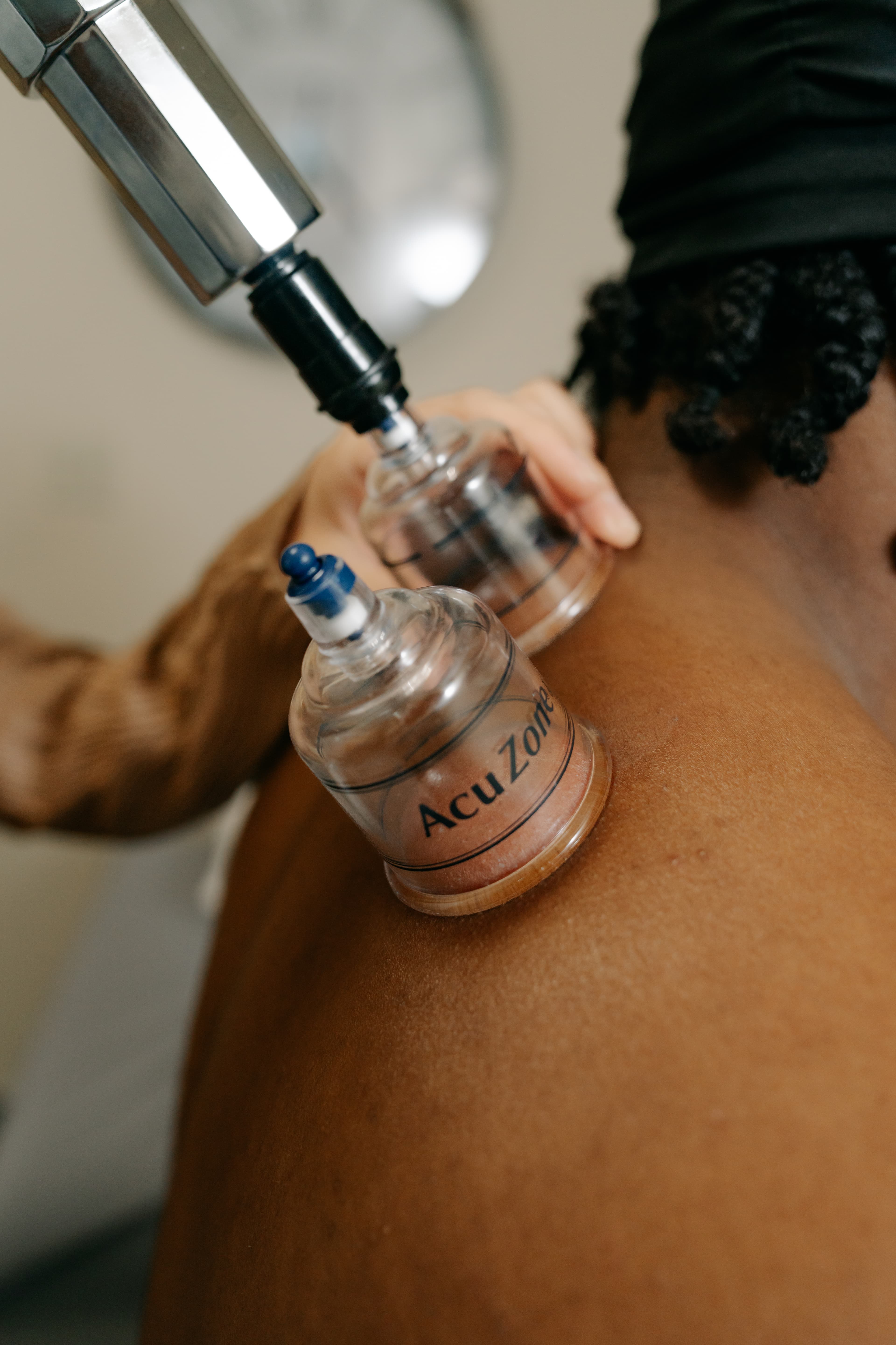 Cupping therapy treatment